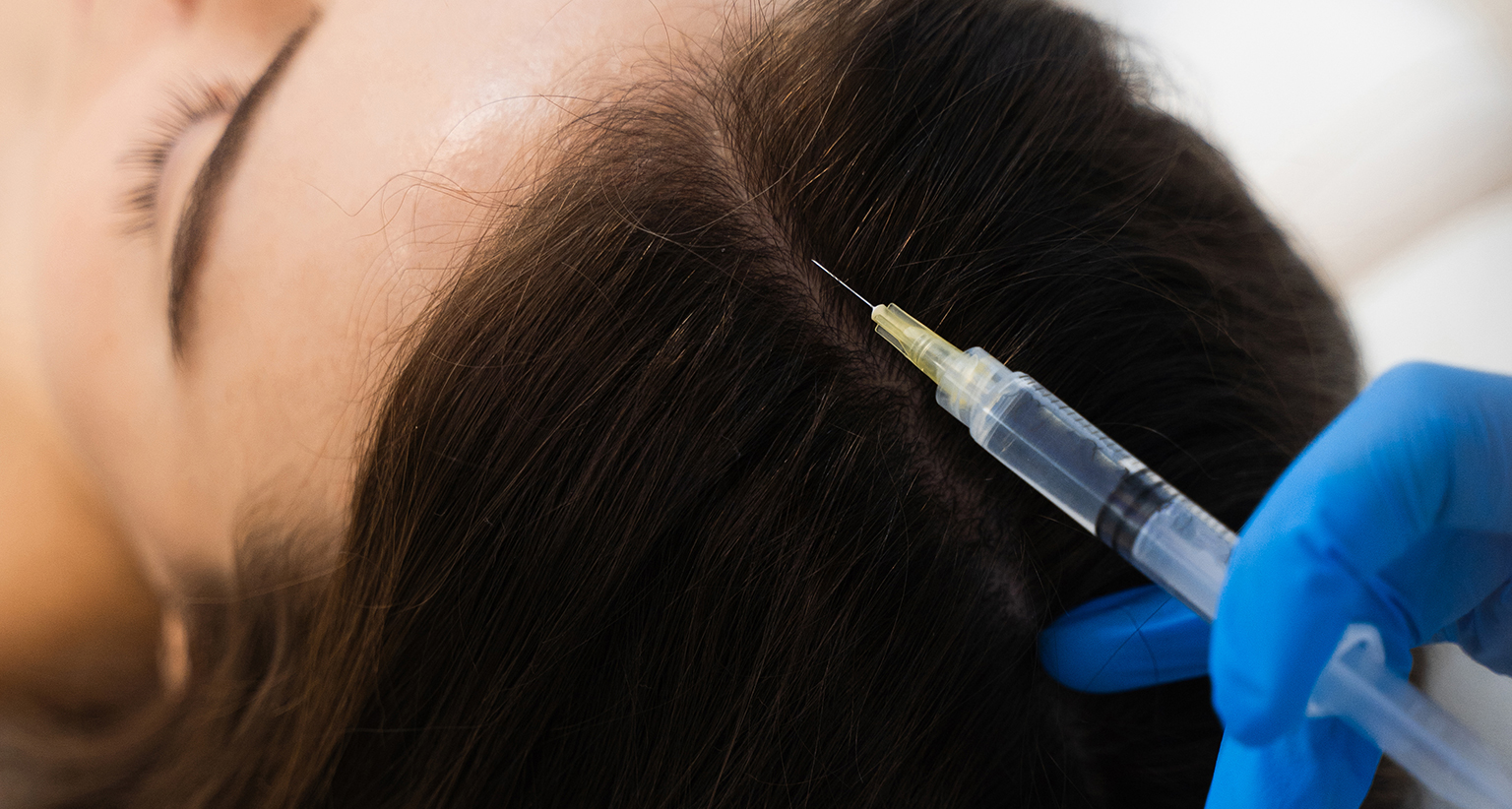 Saç Mezoterapisi